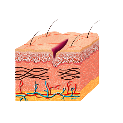 Pele com Fibras Rompidas